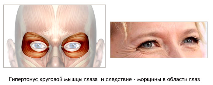 Гипертонус мышц приводит к морщинам вокруг глаз